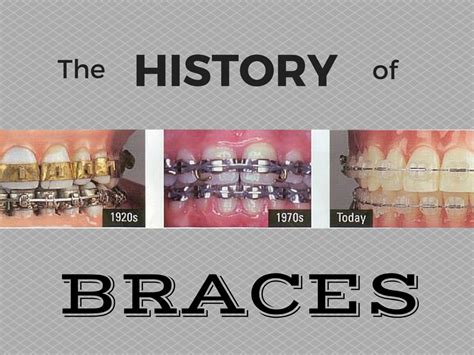 when were dental braces invented